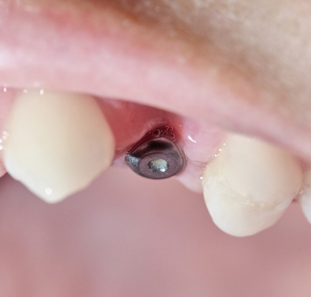 Real mouth with dental molar screw implant.
